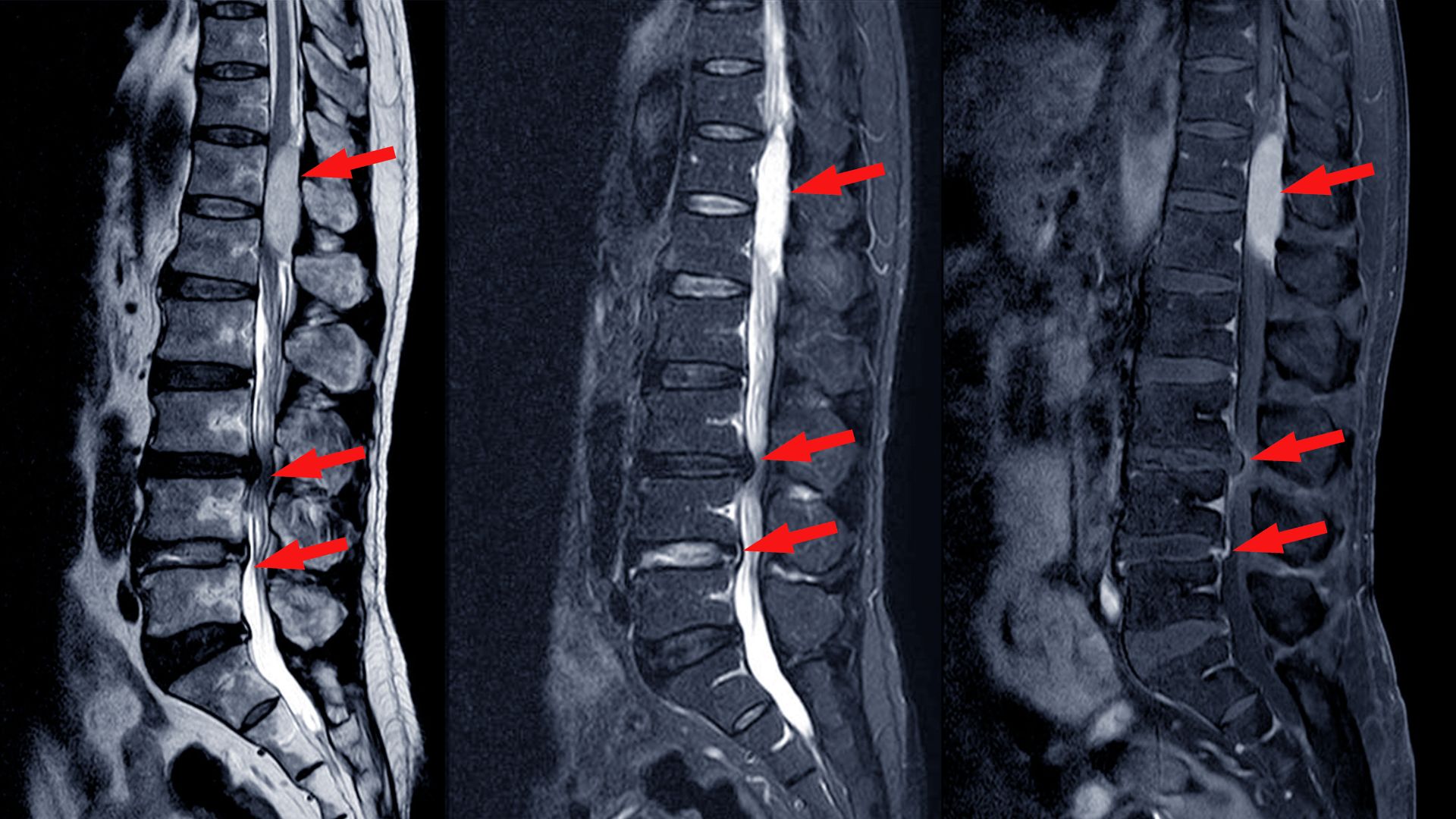 Man siet drei Röntgenaufnahmen der unteren Wirbelsäulen mit den typischen Einengungen der Spinalkanalstenose, gekennzeichnet durch rote Pfeile.